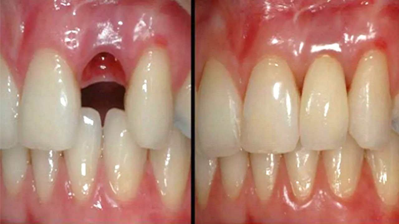 ახალი კბილის გაზრდა 9 კვირაში: პროცედურა, რომელიც ნებისმიერ ასაკშია შესაძლებელი!