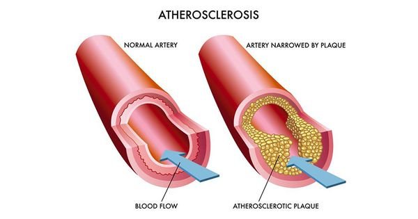 დაივიწყეთ ათეროსკლეროზი, გულ-სისხლძარღვთა სისტემის დაავადებები და ქრონიკული დაღლილობა