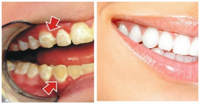 4 ყველაზე მარტივი და იაფი საშუალება, რომელიც კბილებს 5 წუთში ათეთრებს. არა ნადებს!