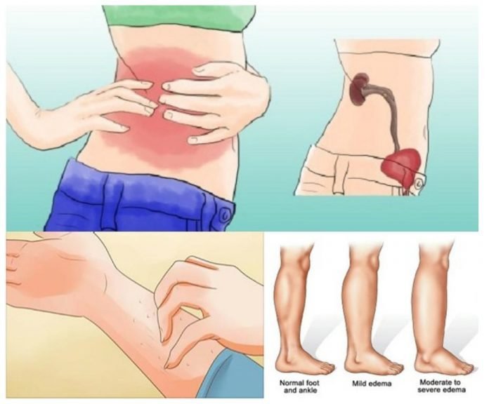 8 გამოკვეთილი ნიშანი იმისა, რომ თქვენი თირკმელები საფრთხეშია!