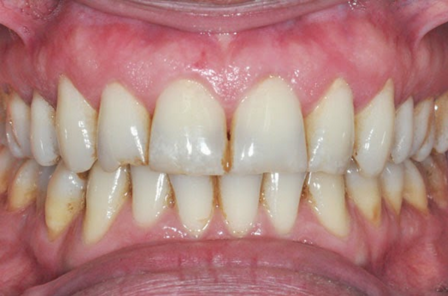 როგორ მოვიშოროთ კბილის ნადები სტომატოლოგთან ვიზიტის გარეშე? მარტივი და ეფექტურია!