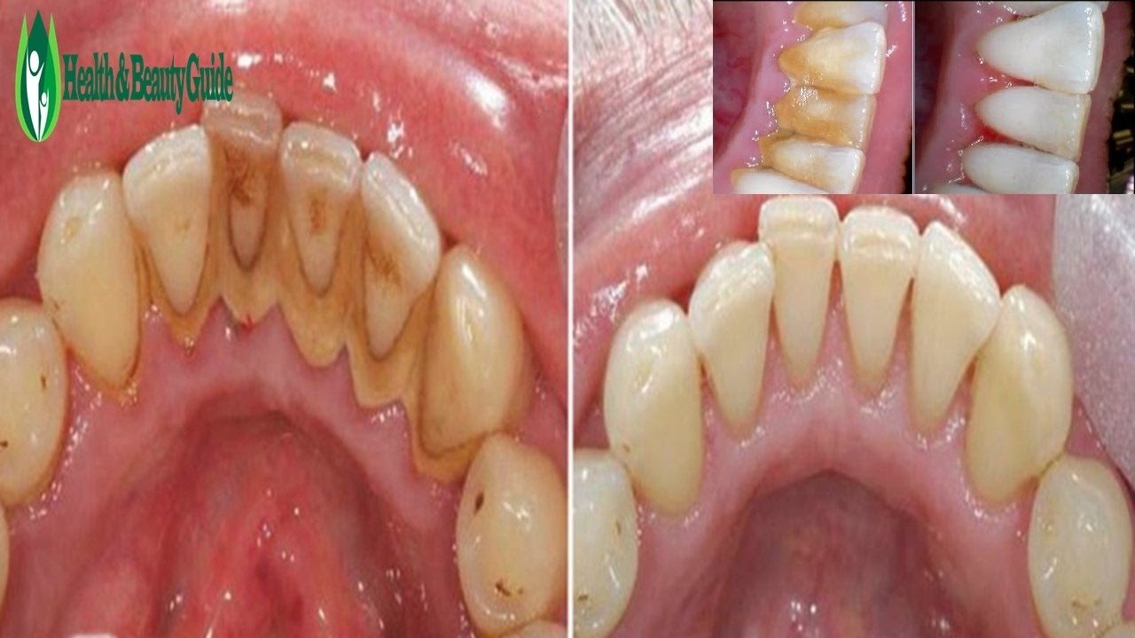 როგორ მოვიშოროთ კბილის ქვა სამუდამოდ სტომატოლოგის გარეშე. ეფექტური საშუალებაა!