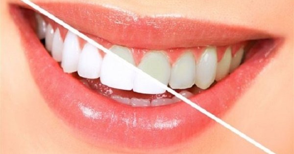 როგორ გავითეთროთ კბილები 3 წუთში სახლის პირობებში (+ვიდეო გაკვეთილი)