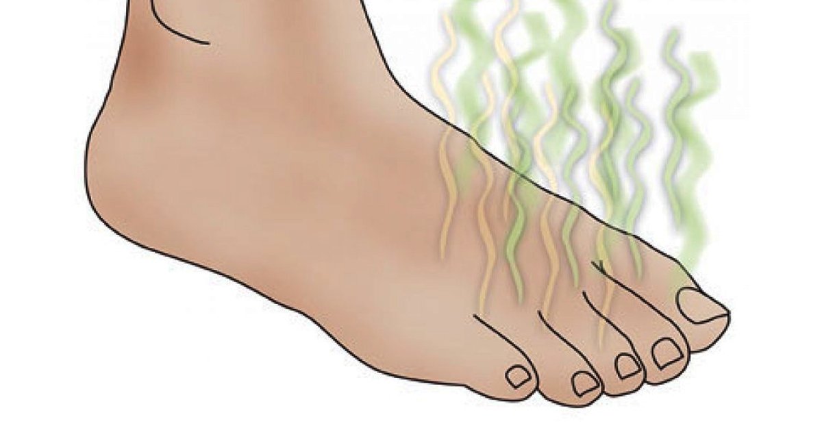 ეს გამოცდილი 5 საშუალება მოგაცილებთ ფეხის უსიამოვნო სუნს
