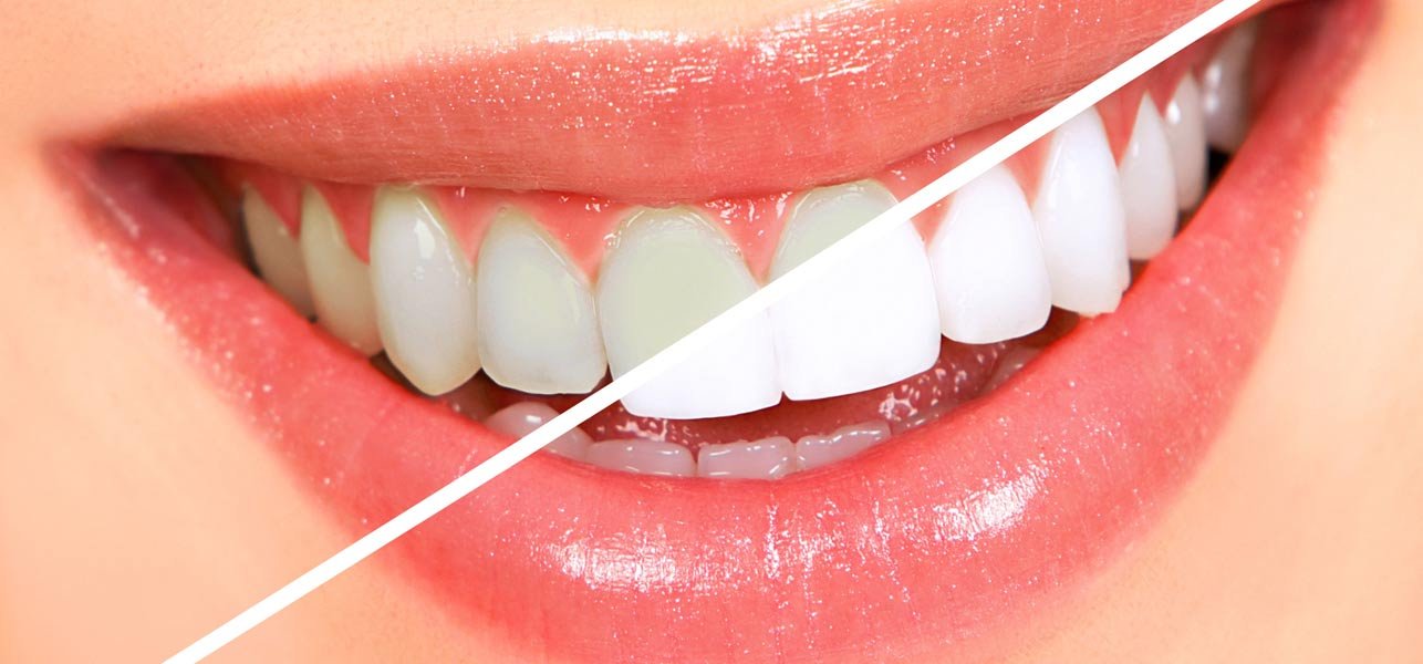 როგორ გავითეთროთ კბილები 3 წუთში? ამ მეთოდის ეფექტურობა ეჭვგარეშეა!