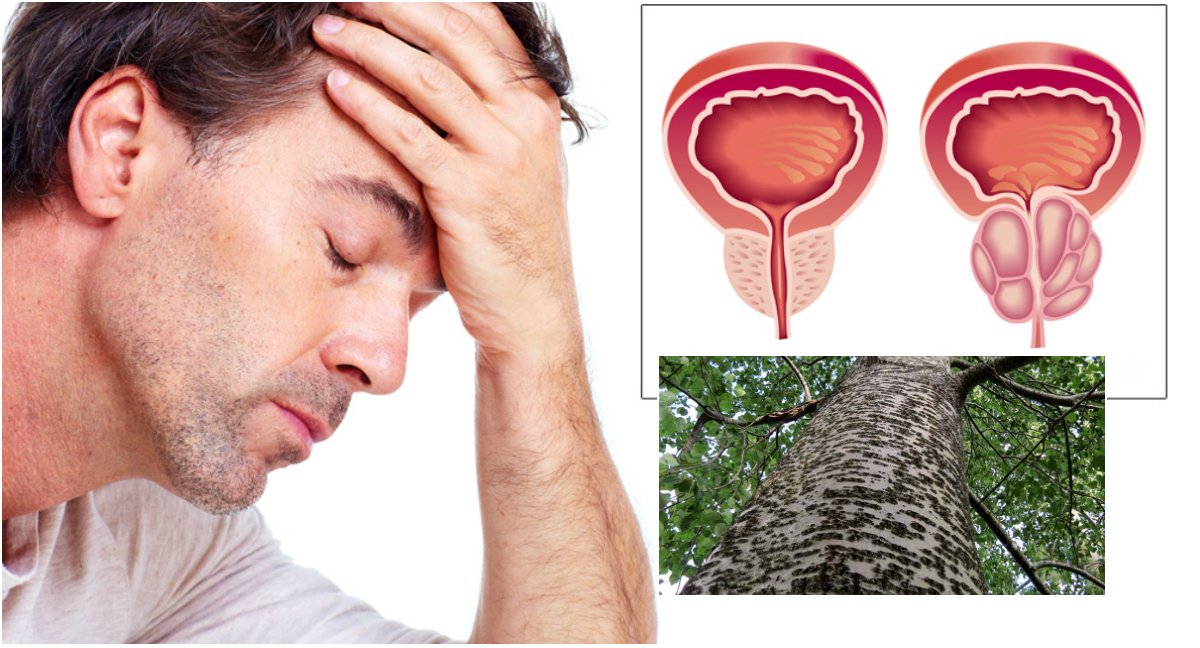 ვერხვის ხის ქერქი იდეალური საშუალებაა პროსტატის ადენომის და სხვათა დაავადებების სამკურნალოდ