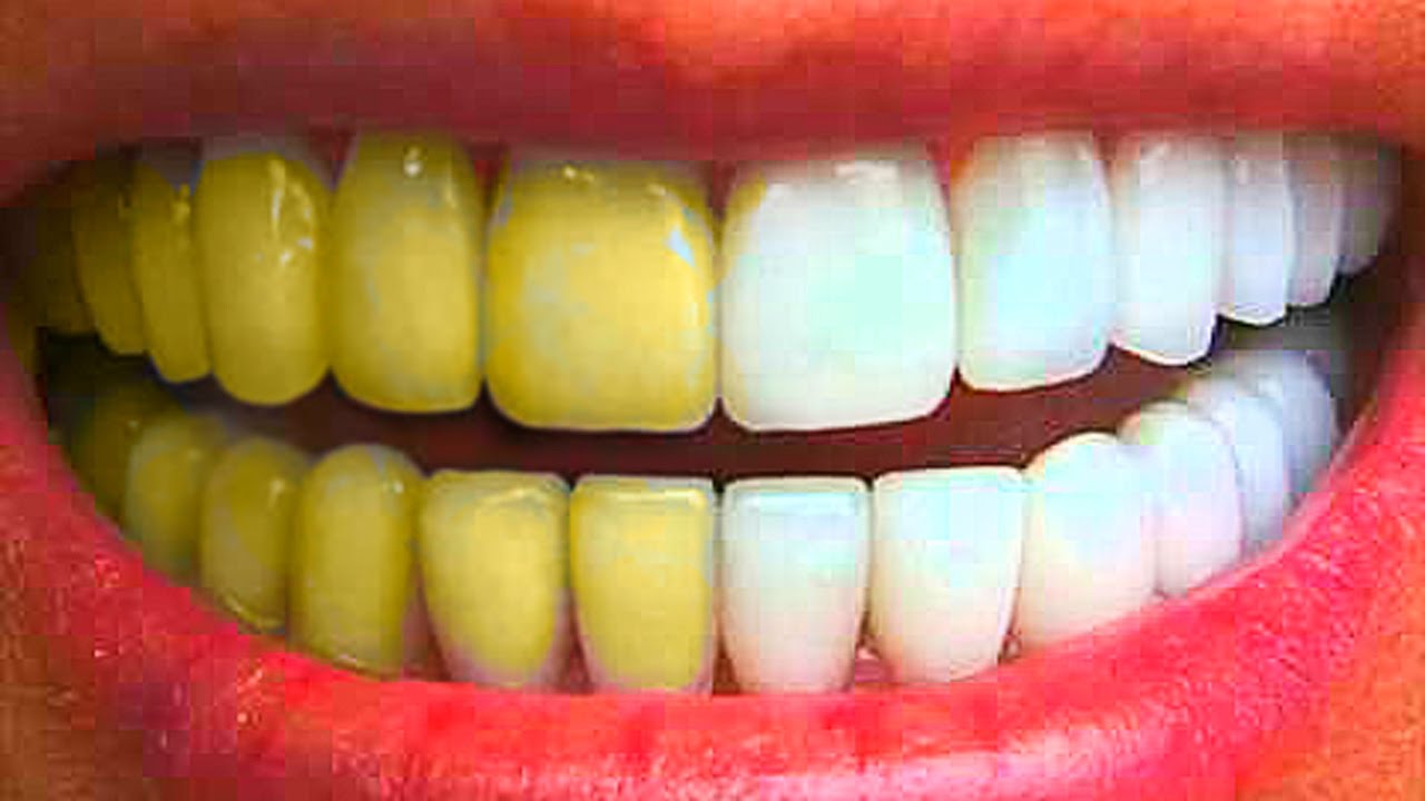 როგორ გავითეთროთ კბილები სულ რაღაც 3 წუთში: მეთოდი, რომელიც 100%_ით მუშაობს!