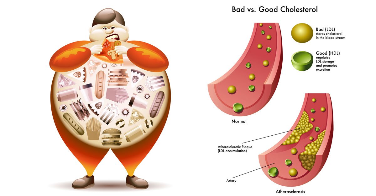 რომელი ორგანოს დაავადება იწვევს  სისხლში  ქოლესტერინის  მოჭარბებას და  რით შეიძლება მისი მკურნალობა.