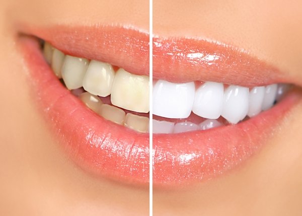 8 ნატურალური, ყველაზე მარტივი და ეფექტური მეთოდი კბილების გასათეთრებლად.