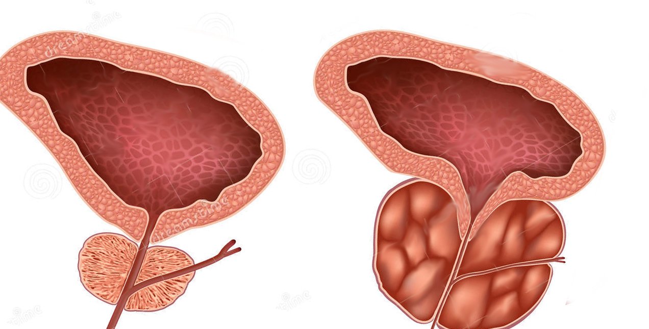 Гиперплазия предстательной железы 1. Боль в предстательной железе. Предстательная железа кровь.