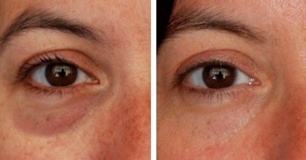 გელი თვალის გარშემო არსებული კანისთვის: საშუალება, რომელიც ნაოჭებს რამდენიმე დღეში გვაშორებს