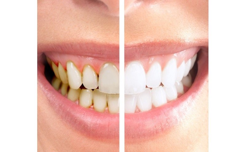 კბილების მათეთრებელი ნატურალური საშუალება. დაუბრუნეთ თქვენს ღიმილს სიქათქათე!