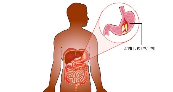 როგორ ვუმკურნალოთ კუჭის წყლულს ხალხური მეთოდით