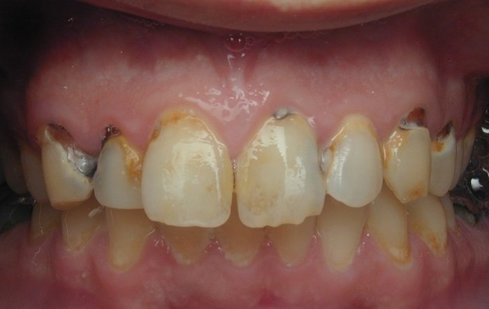 6 რჩევა კბილების მოვლასთან დაკავშირებით. თქვენ არასდროს მოგიწევთ სტომატოლოგთან ვიზიტი