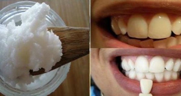 1 ინგრედიენტი გაგითეთრებთ კბილებს, დაგავიწყებთ უსიამოვნო სუნს და მოგაშორებთ კბილის ქვას