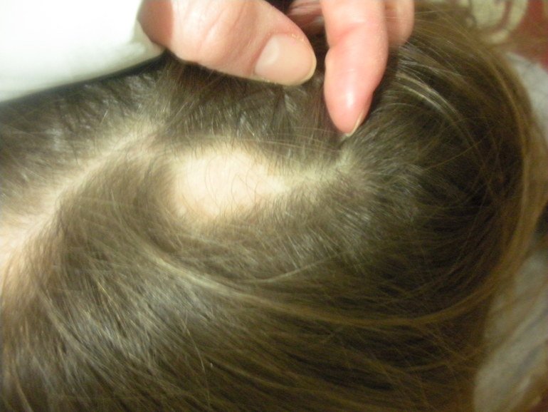კანისა და თმის სოკოვანი დაავადების სამკურნალო  ხალხური საშუალებები