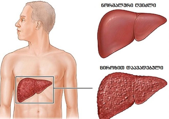 როგორ ვუმკურნალოთ ციროზს მარტივი ხალხური რეცეპტით