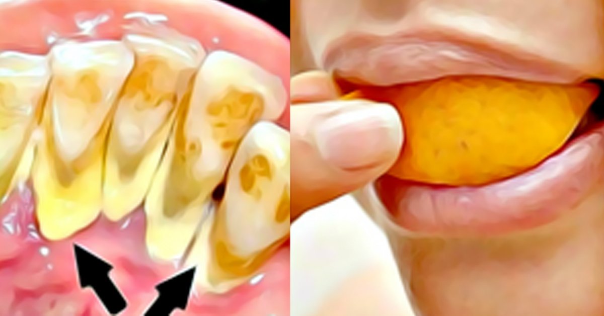 აი, როგორ უნდა მოიცილოთ კბილის ქვა და ნადები სტომატოლოგის გარეშე!