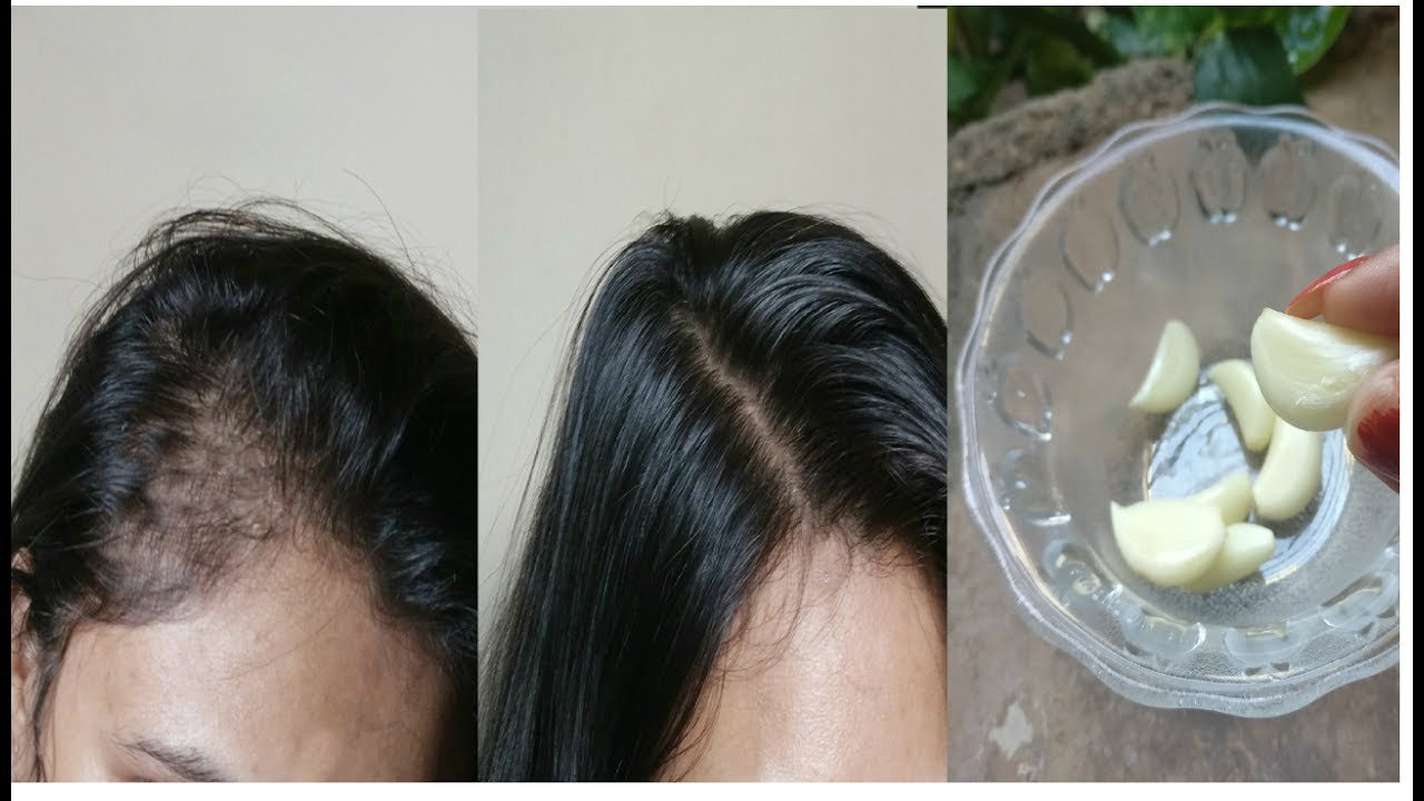 თმის ცვენის სამკურნალო ბუნებრივი  და ხალხური საშუალებები